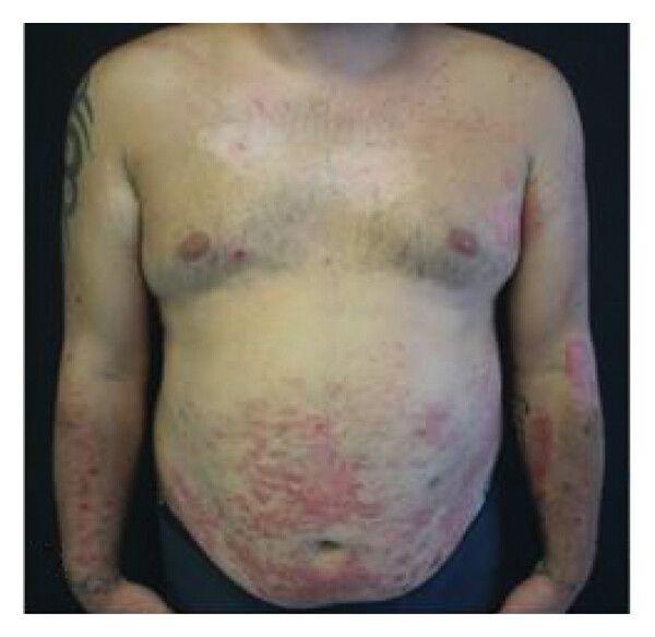 Clinical image of patient before incorporating dupilumab into treatment plan | Image Credit: © 2024 Niccolò Gori et al.