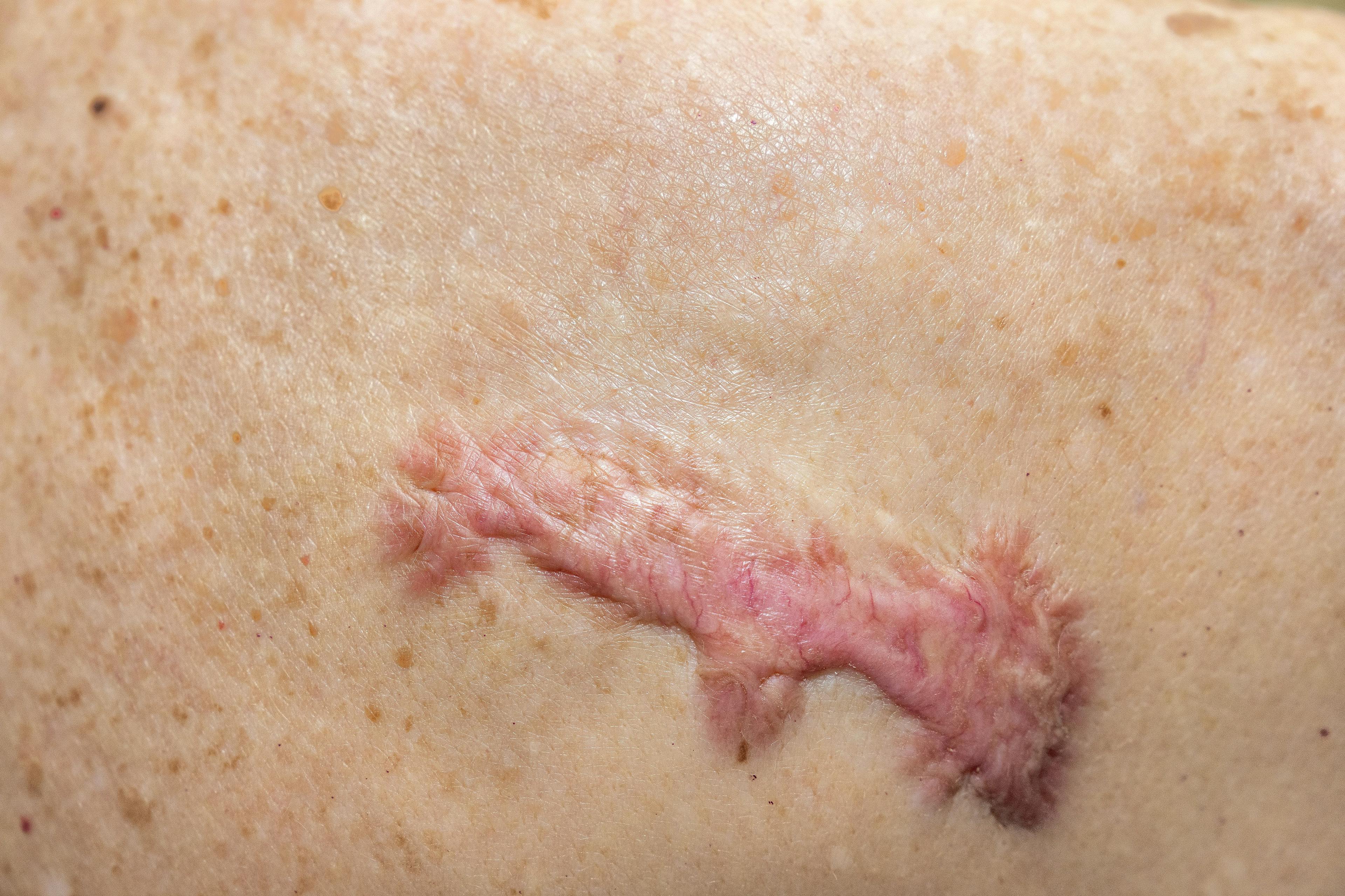 Electroablation Plus Pharmacotherapy Leads to Reduction in Keloid Volume