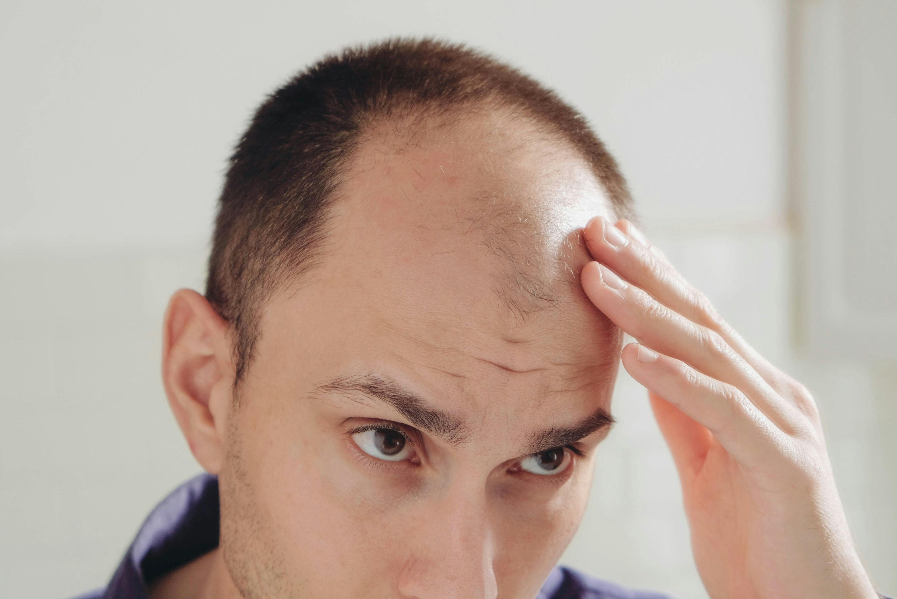 Man with pattern hair loss looking in mirror