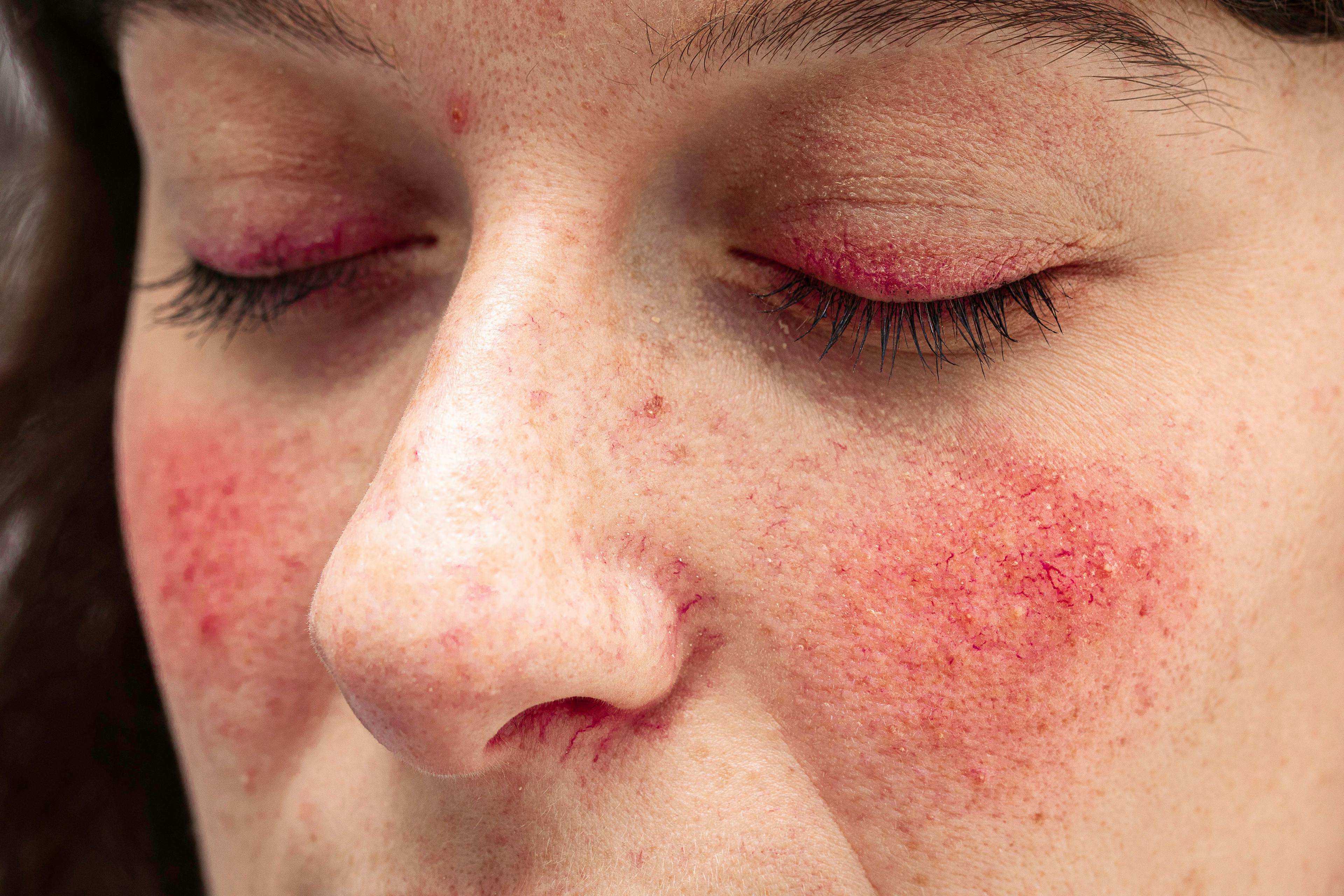 Woman with rosacea | Image Credit: © Alessandro Grandini - stock.adobe.com