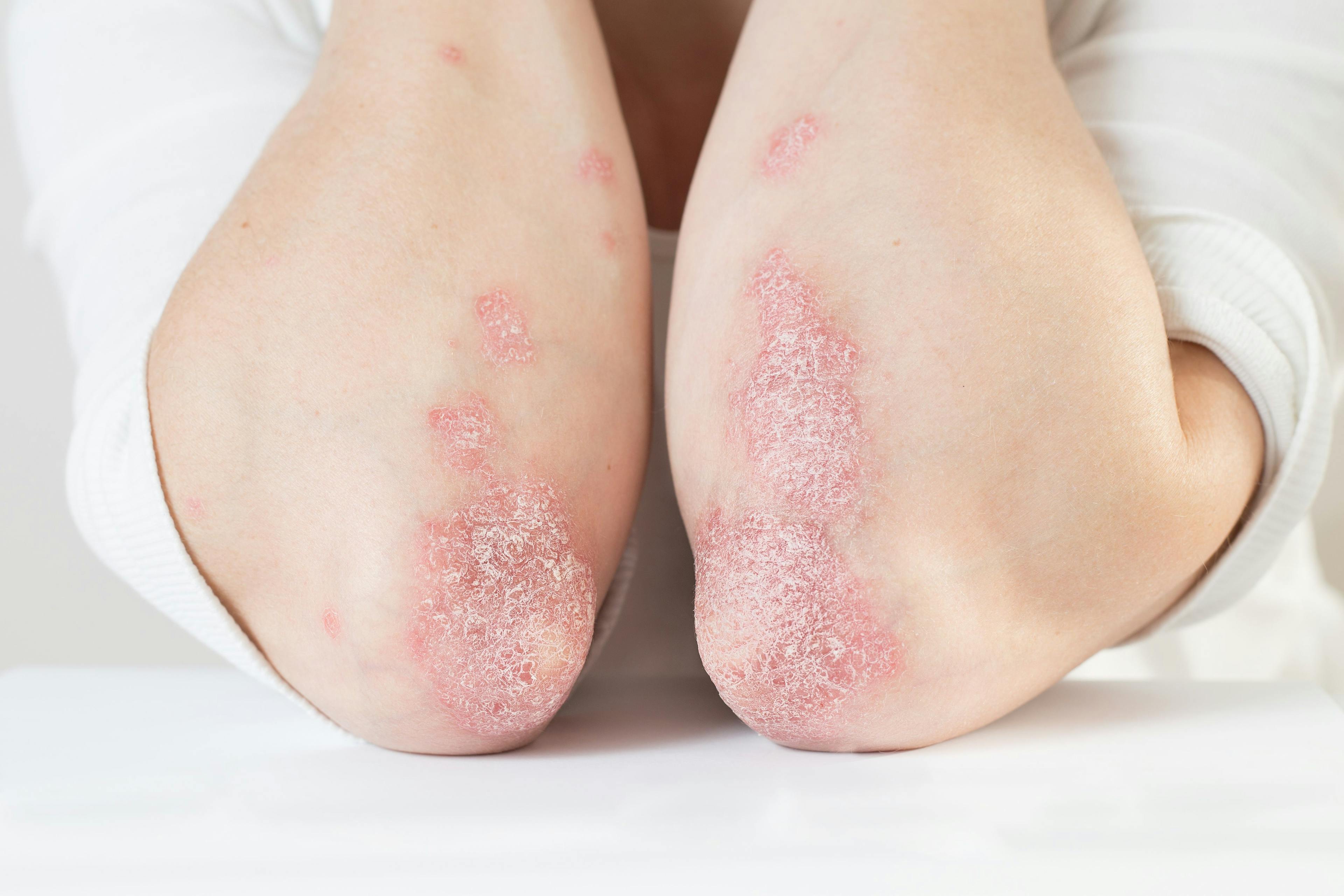 New Research Finds Shared Decision-Making Beneficial in Care of Patients With Eczema    