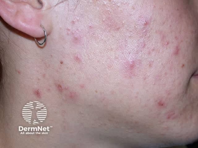 moderate acne on face | Image Credit: © dermnetnz.org