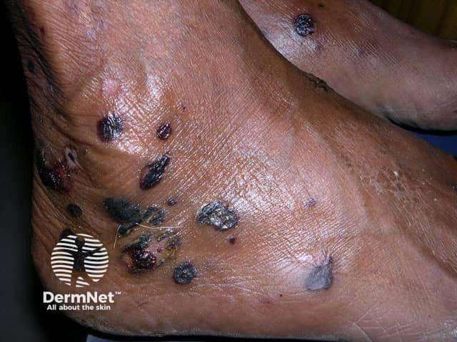 Epidermolysis bullosa acquisita | Image credit: DermNet