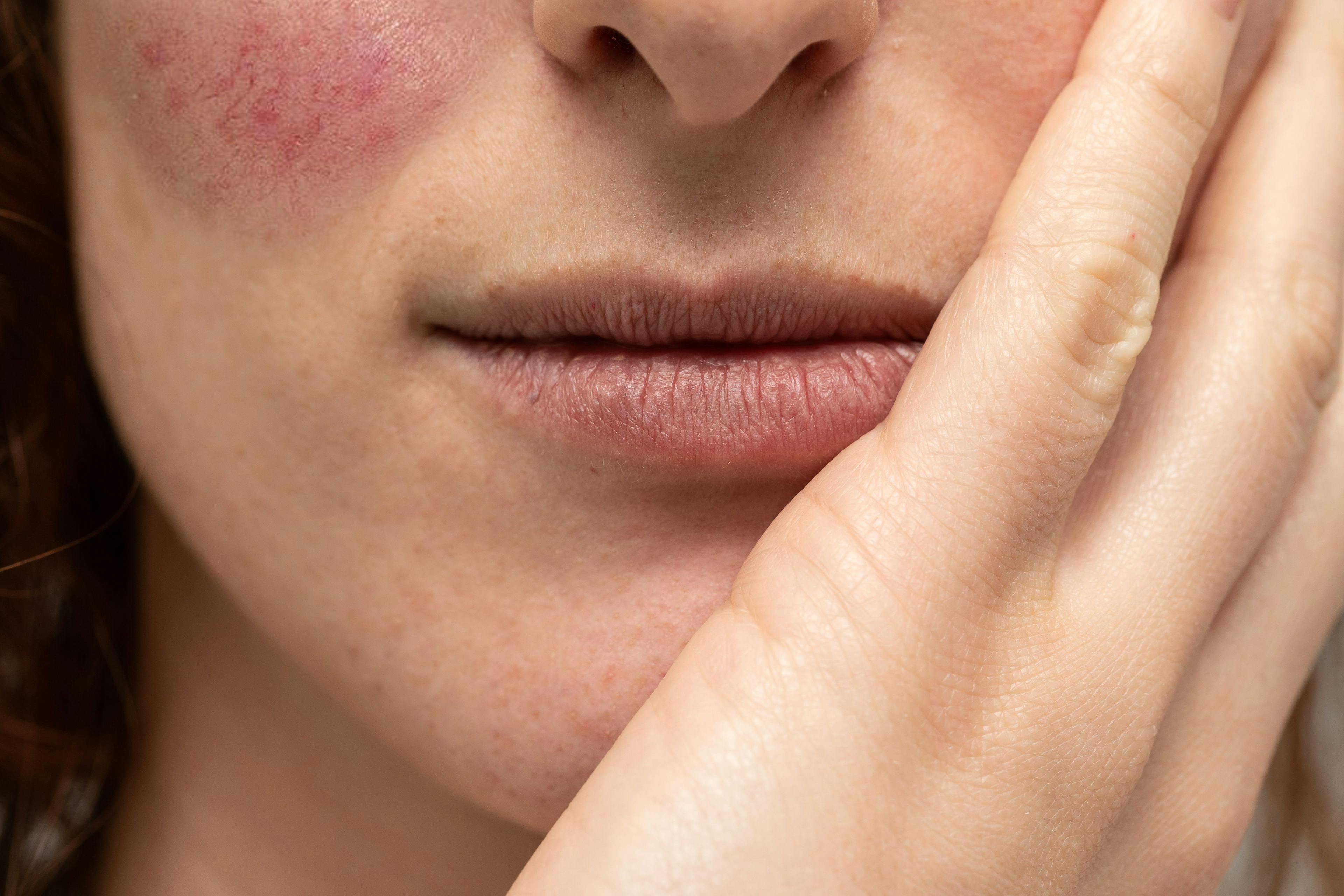 Close up view of woman resting her chin on hand, with rosacea on cheeks
