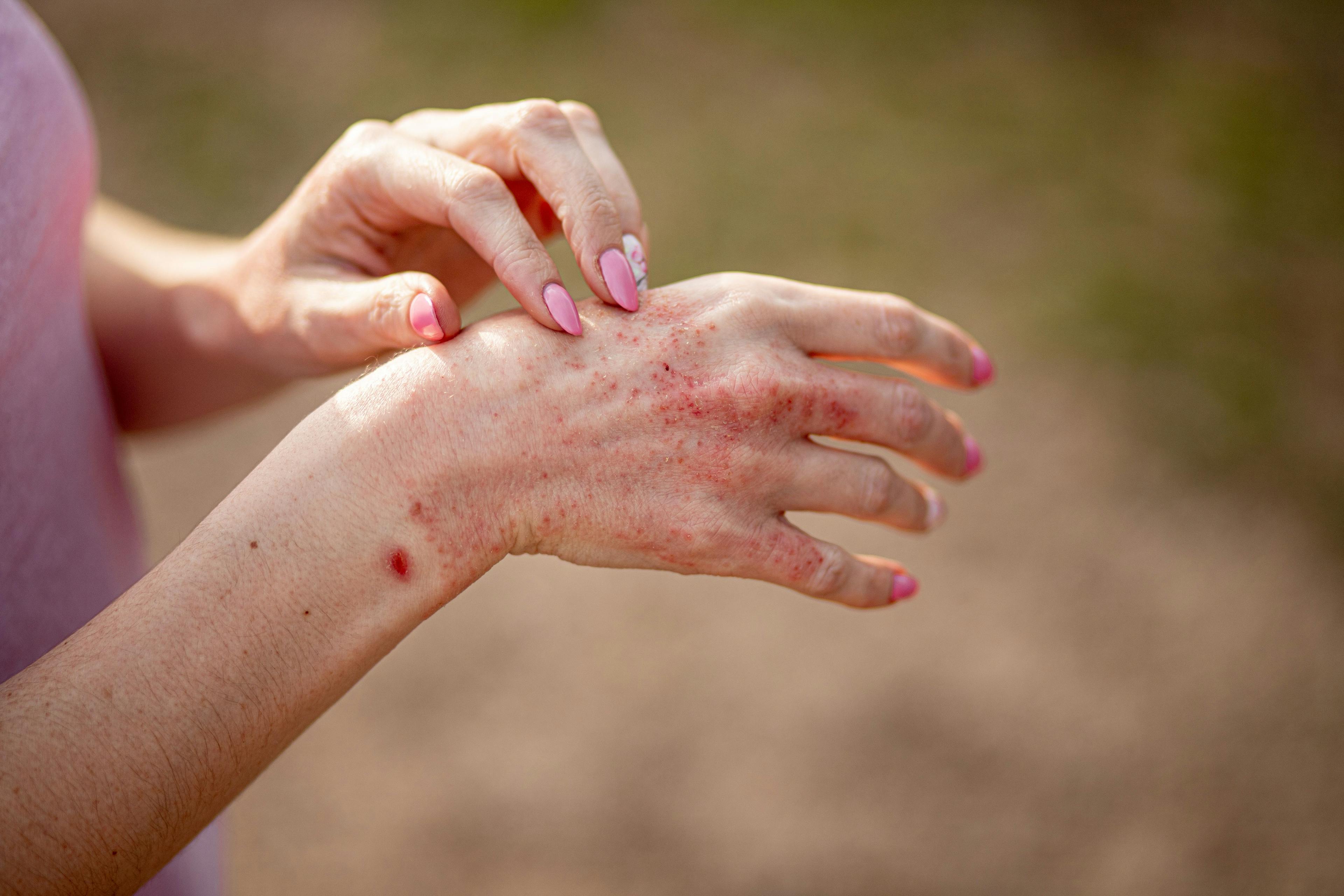 Patient with atopic dermatitis on hands | Image Credit: © InfiniteStudio - stock.adobe.com