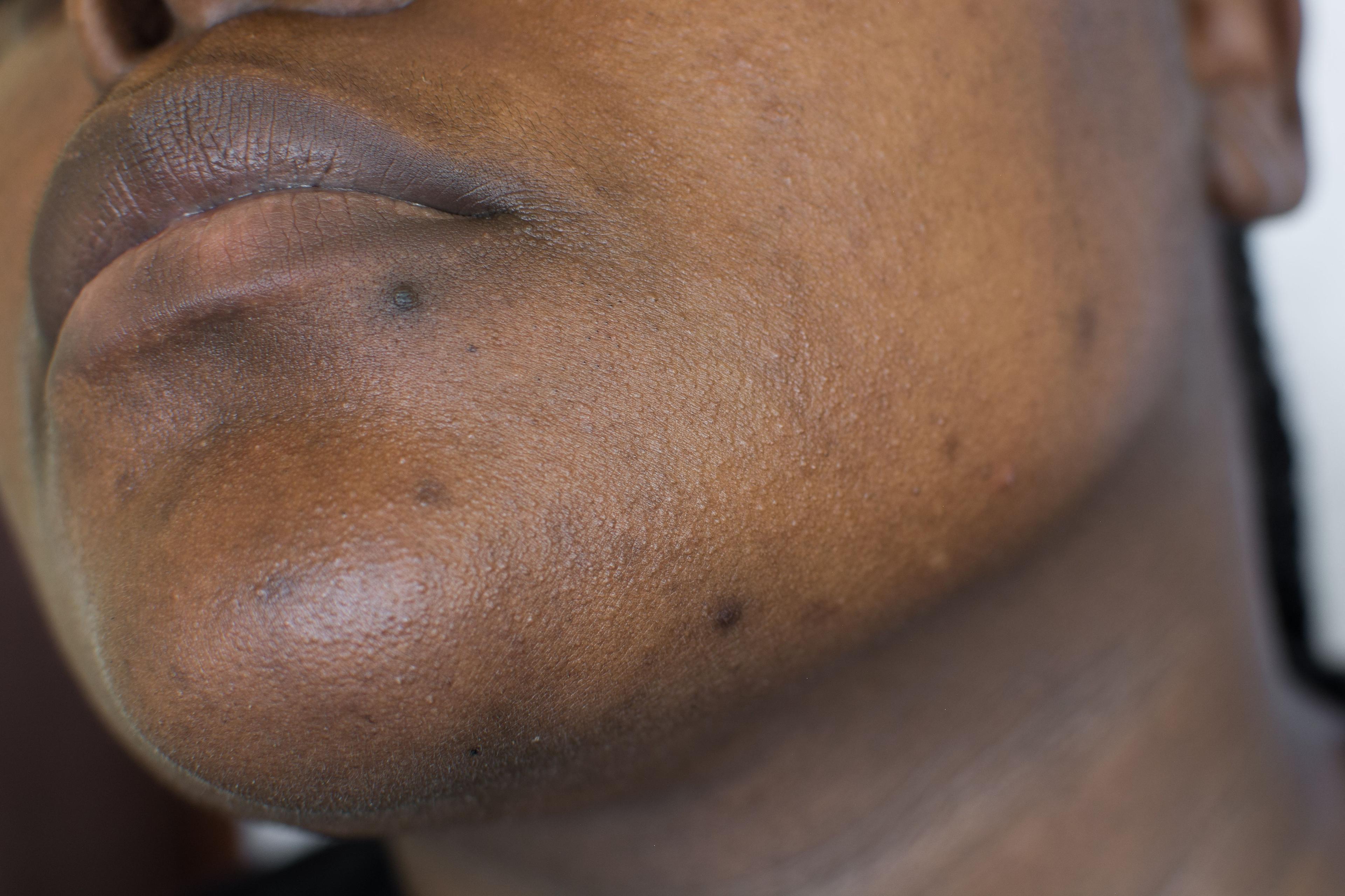 Patient with hyperpigmentation | Image Credit: © this_baker - stock.adobe.com