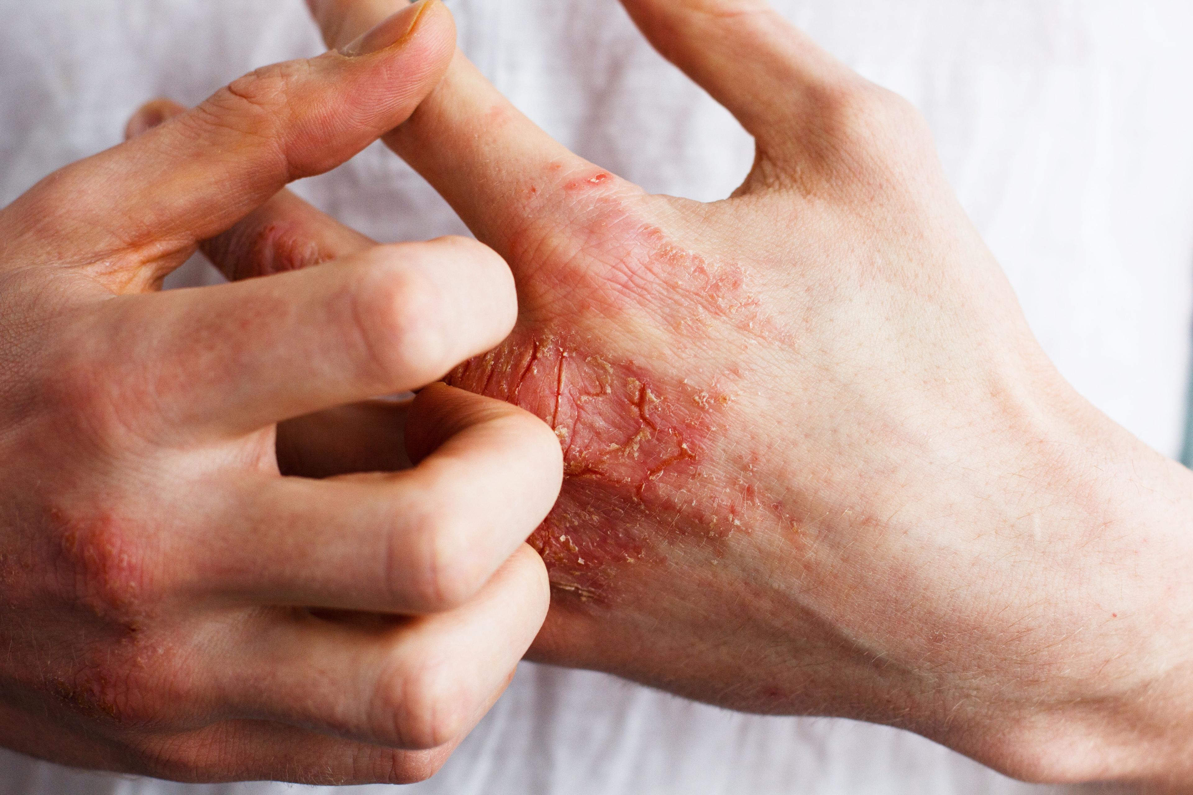 Hands of patient with psoriasis | Image Credit: © Ольга Тернавская - stock.adobe.com