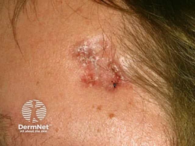 New Clinical Guidelines for Nonmelanoma Skin Cancer Published by Dermatology Association of Radiation Therapy
