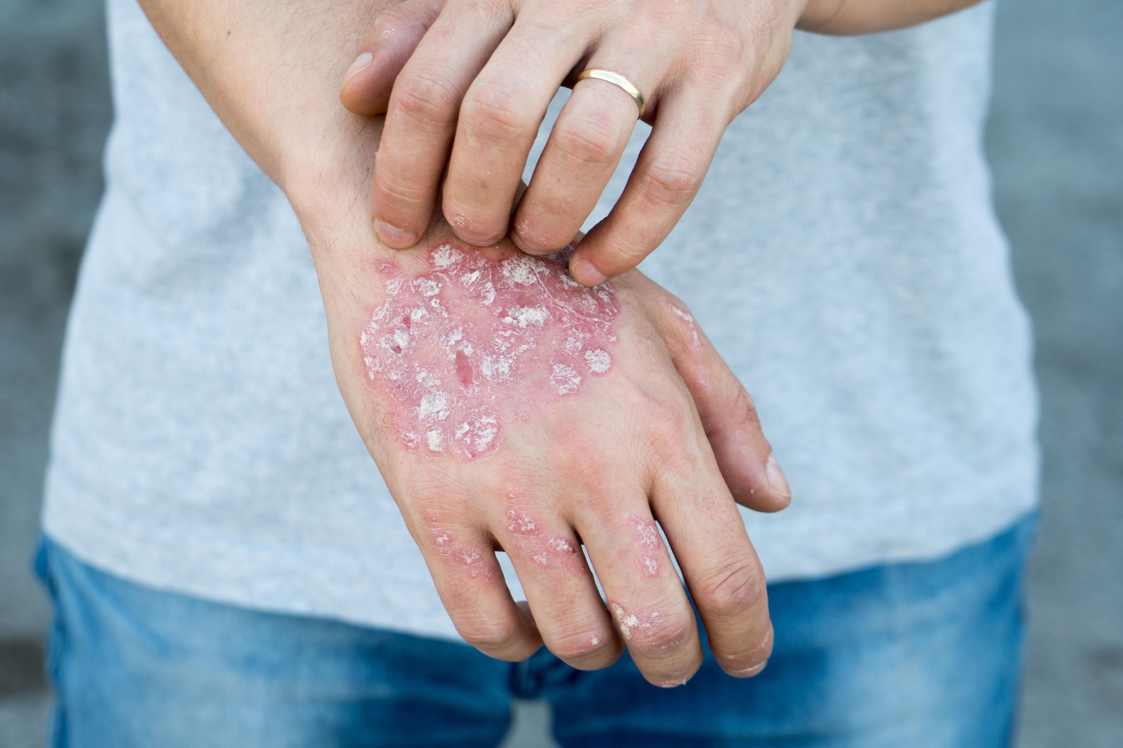 Why You Should You Be Prescribing Tapinarof for Plaque Psoriasis