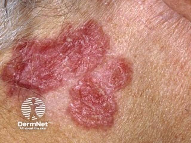 Squamous cell carcinoma on the face