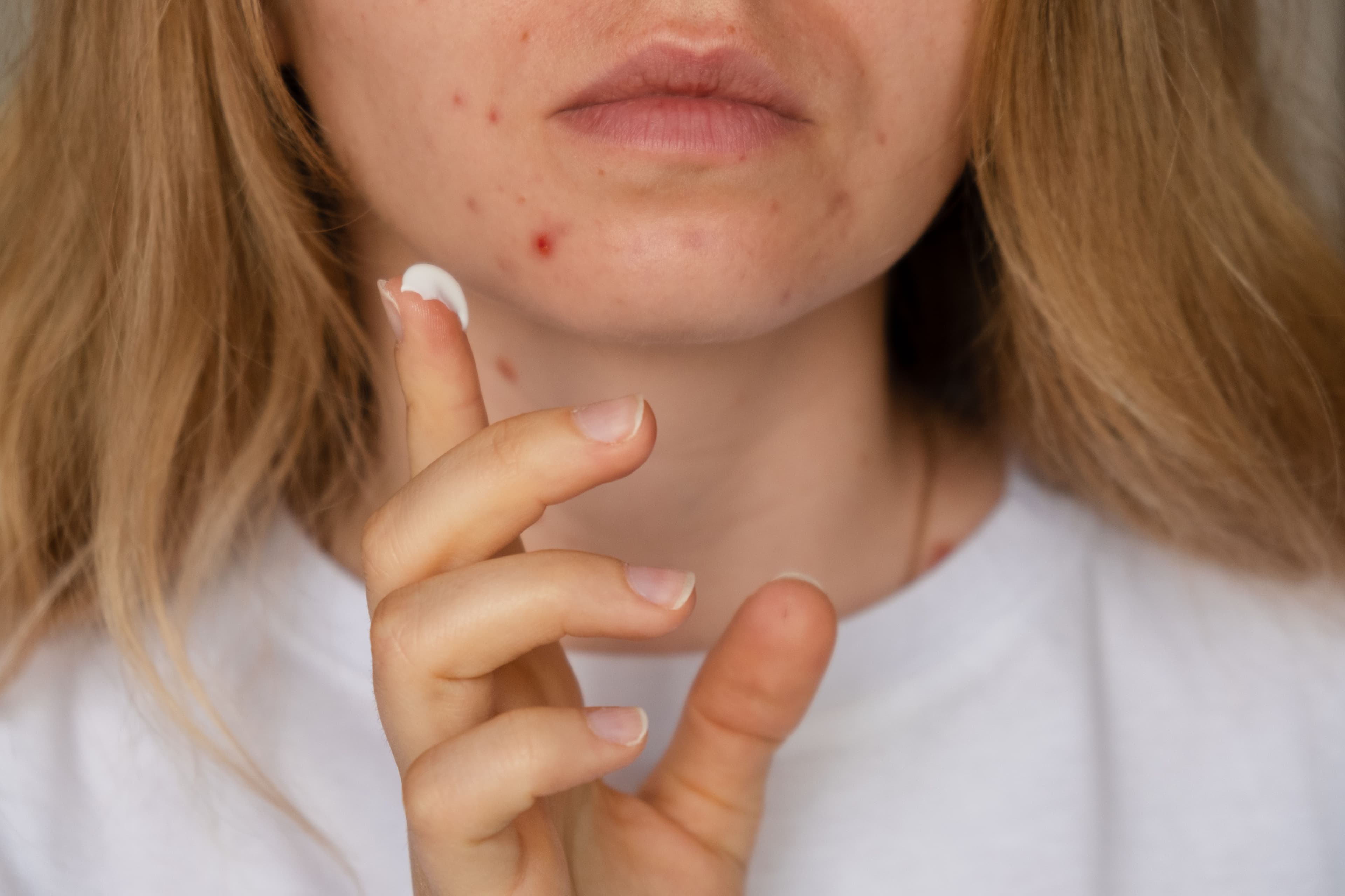 Patient with acne applying cream | Image credit: © anna.stasiia - stock.adobe.com