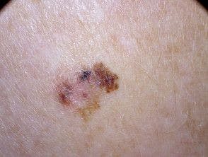 An Increase in Skin Cancer Calls for an Increase in Treatment Options