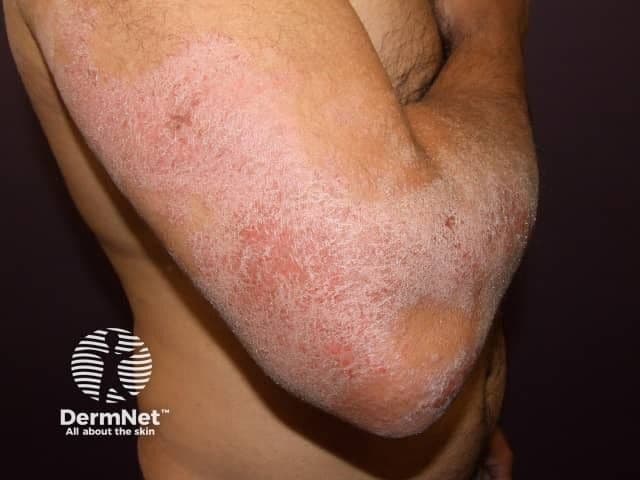 Dry atopic dermatitis in an extensor pattern | Image credit: DermNet