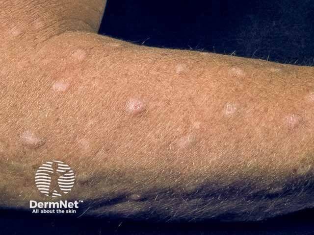 Prurigo nodularis on the arm | Image credit: © DermNet