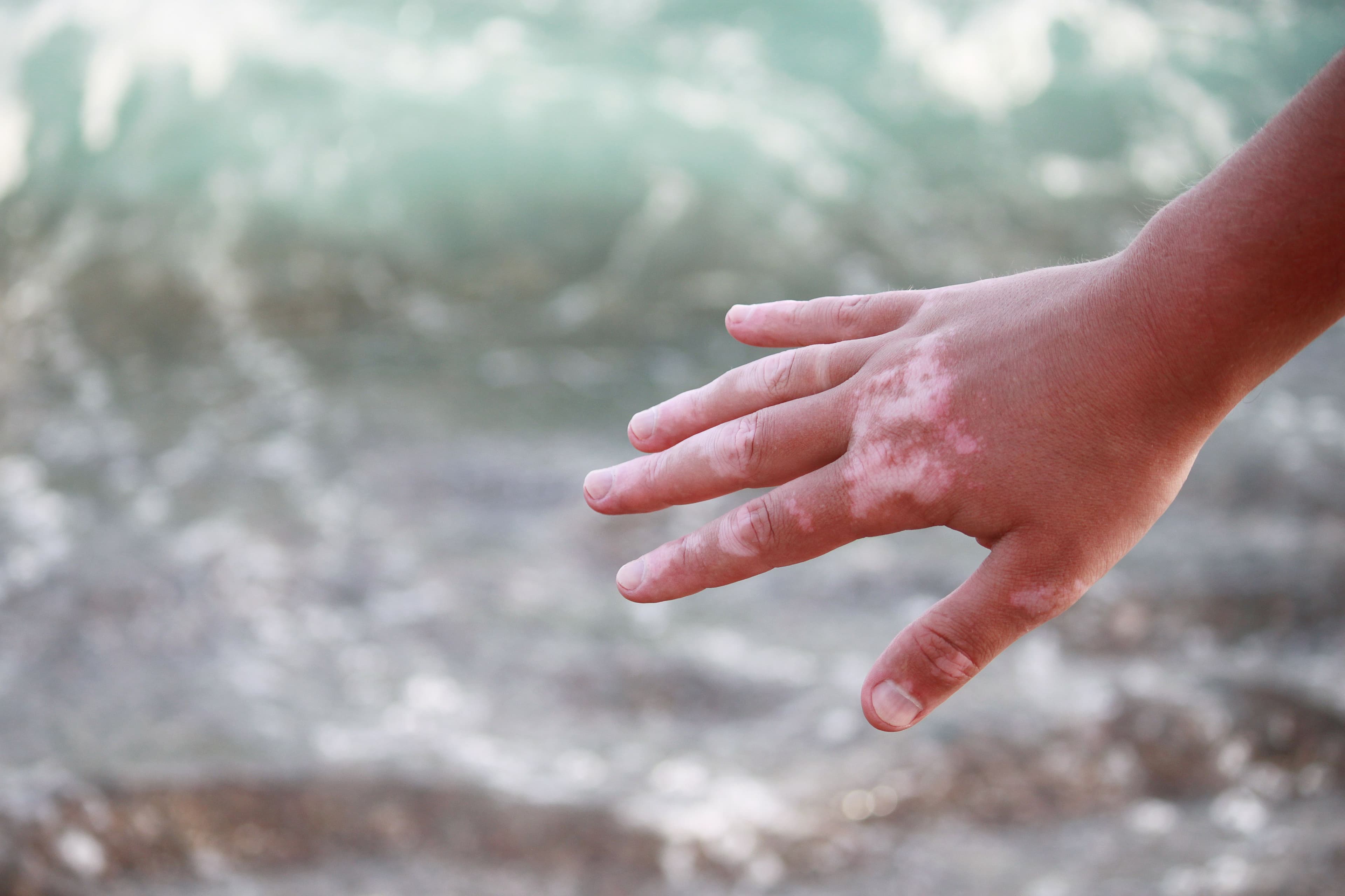 vitiligo on hands | Image Credit: © vittaliya - stock.adobe.com