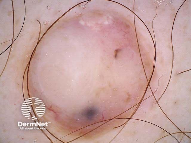 Nodular Melanoma | Image Credit: © dermnetnz.org