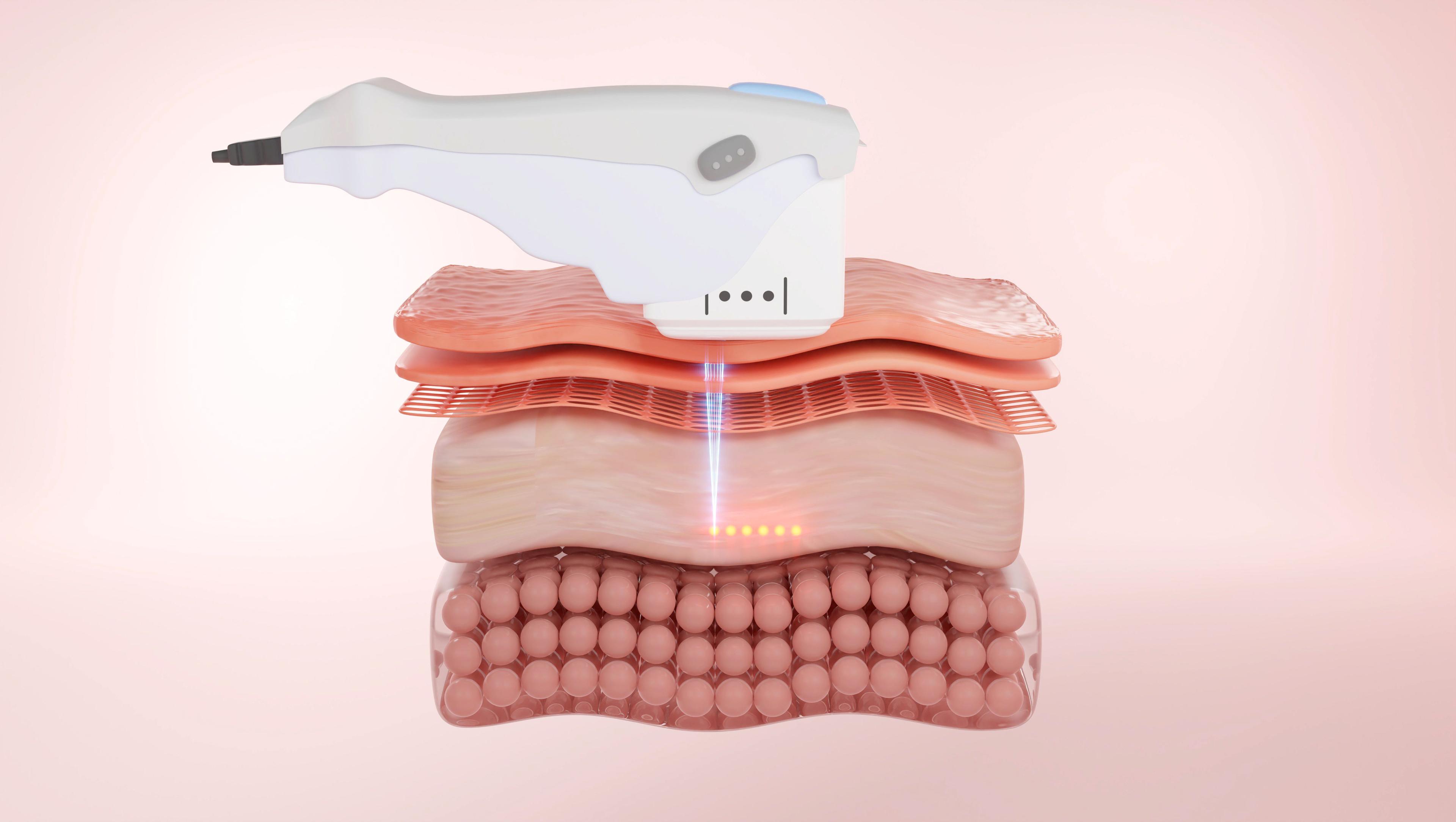 3-D rendering of facial laser treatment to reduce wrinkles and enhance firmness | Image Credit: © wangmando - stock.adobe.com