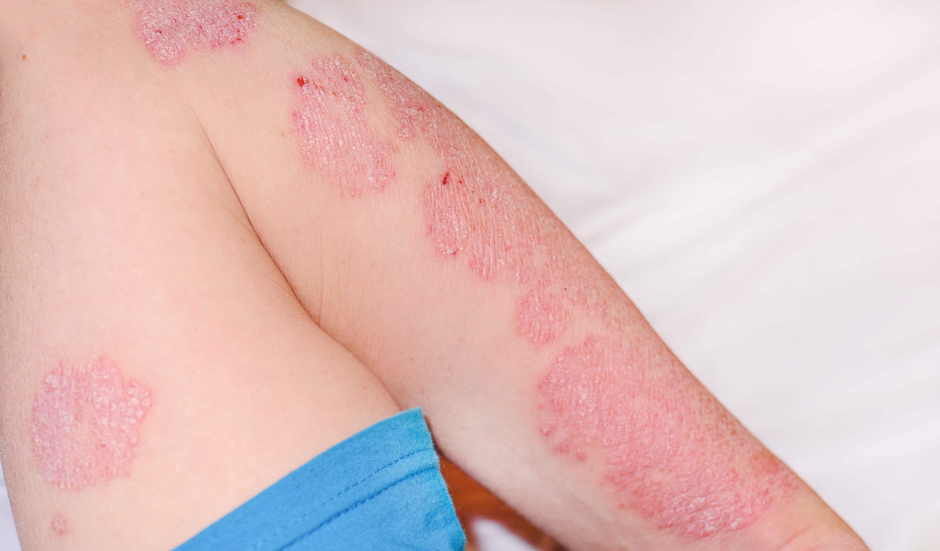 Acute psoriasis on the arm