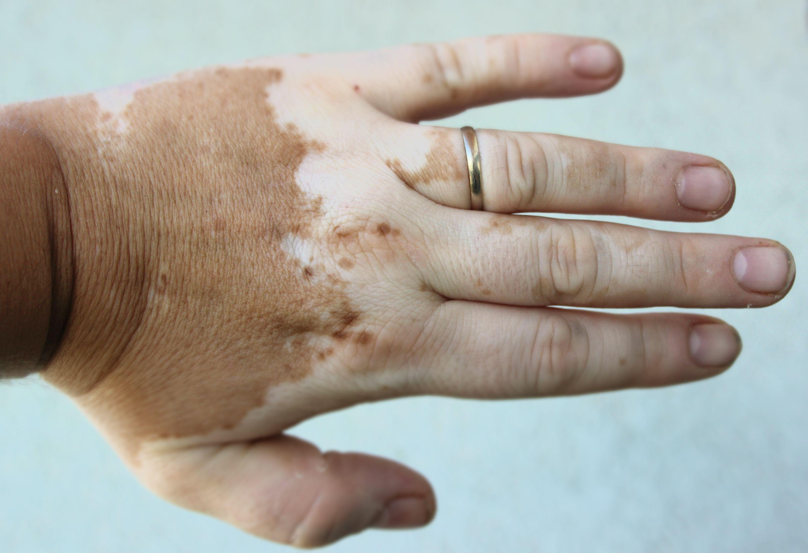 Incyte Announces Positive 52-Week Data at EADV of Povorcitinib for Extensive Nonsegmental Vitiligo 