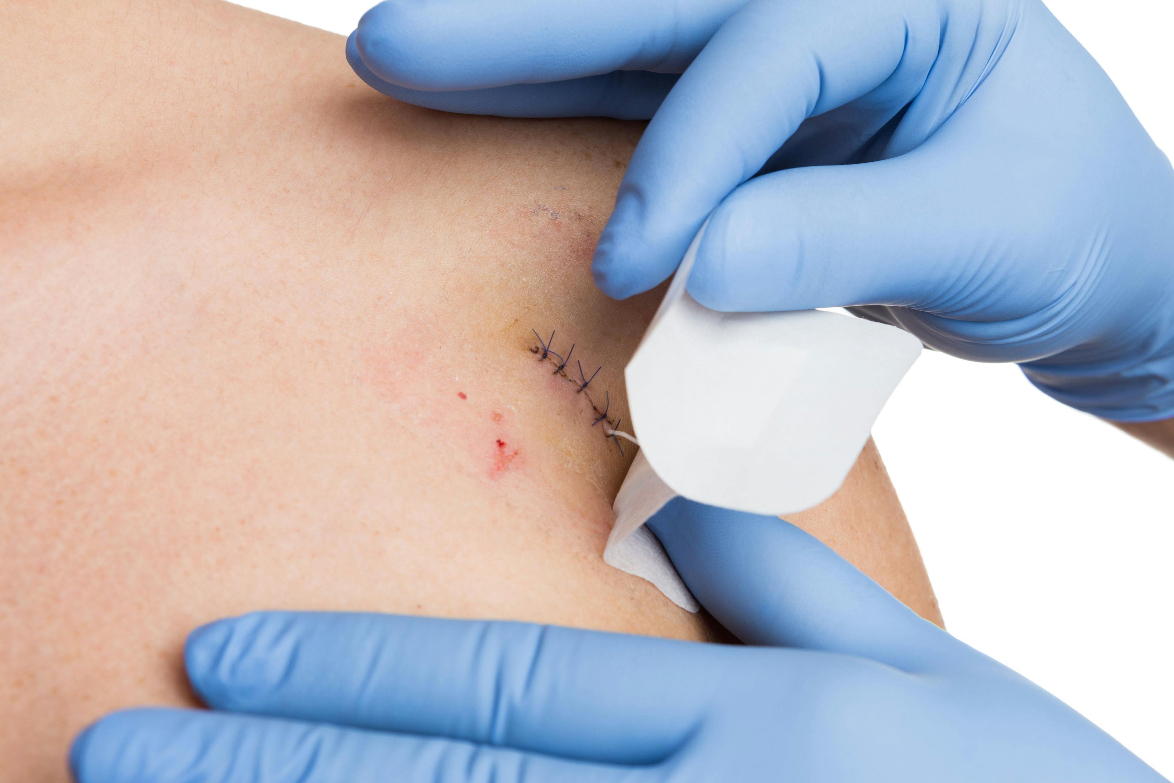 Xkin Suture Device Acts as Effective Wound Closure Method, Improves Scar Outcomes