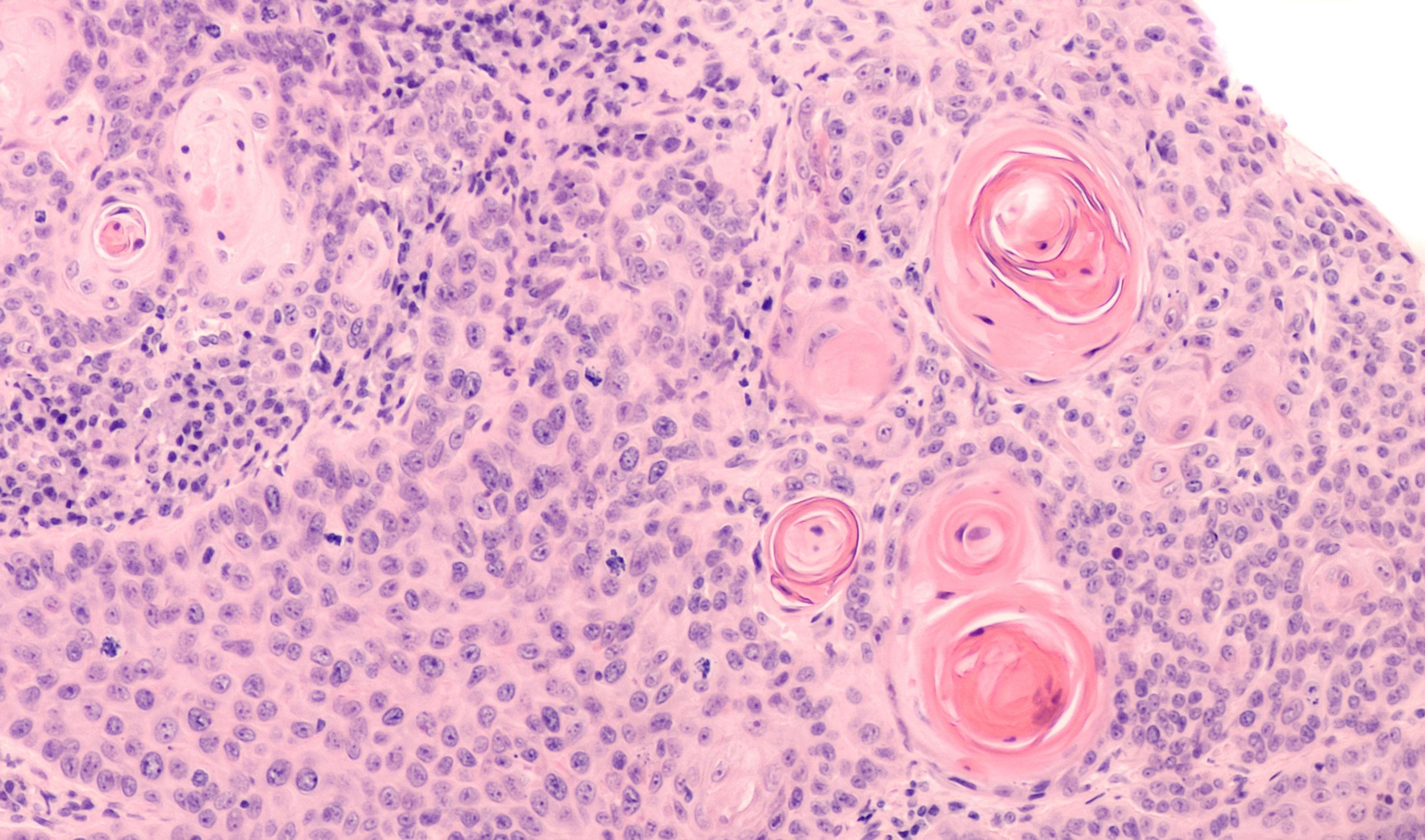 Deep Dive Into High-Risk Cutaneous Squamous Cell Carcinoma 