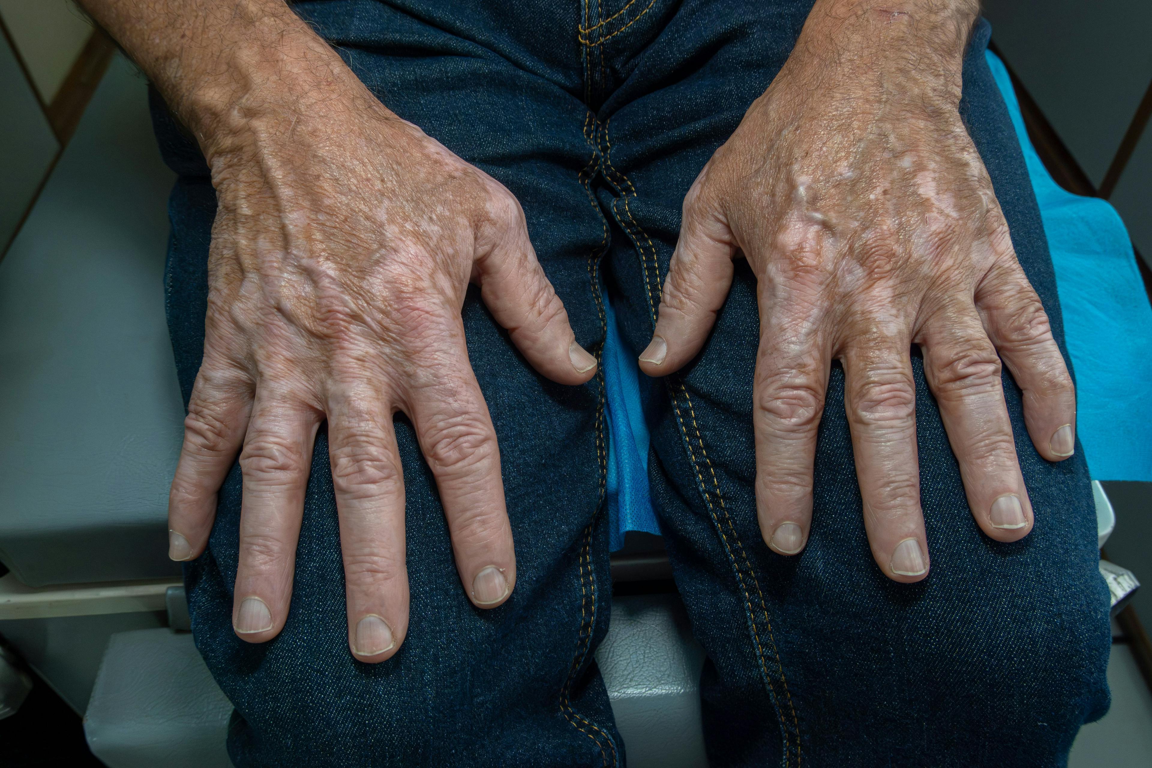 Senior man with vitiligo on the hands