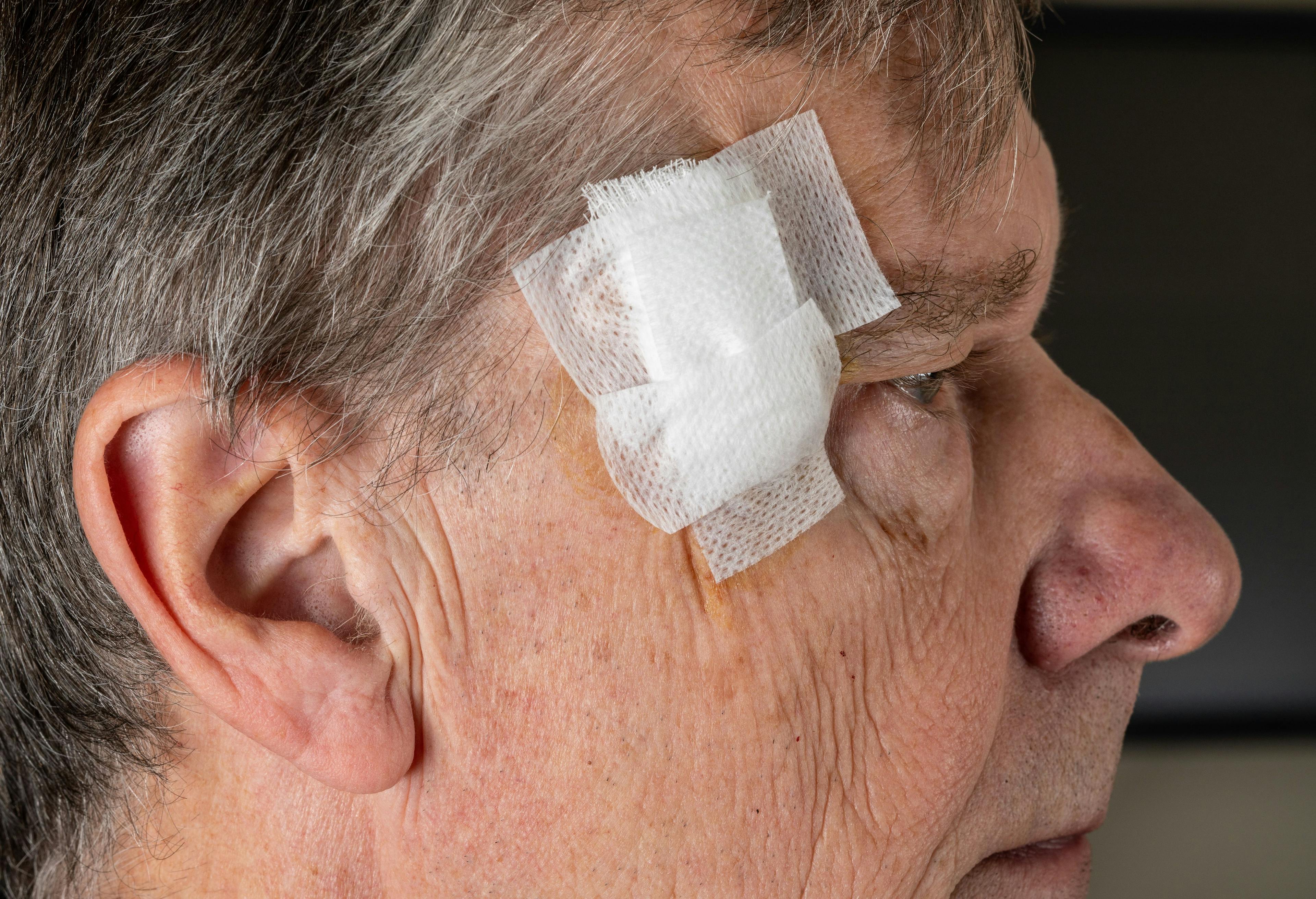 Patient after Mohs surgery | Image Credit: © steheap - stock.adobe.com