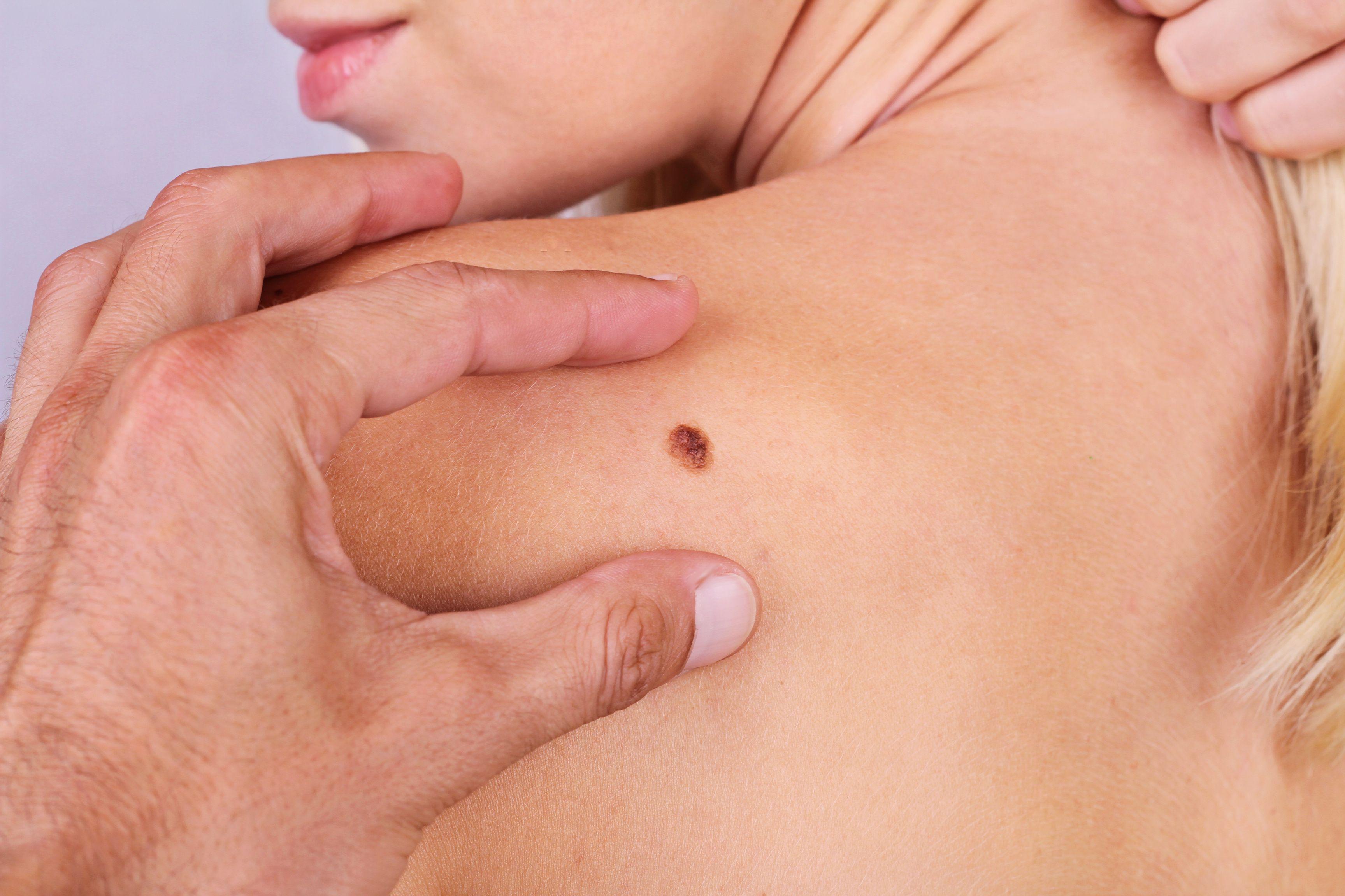 Invasive Melanoma Management  