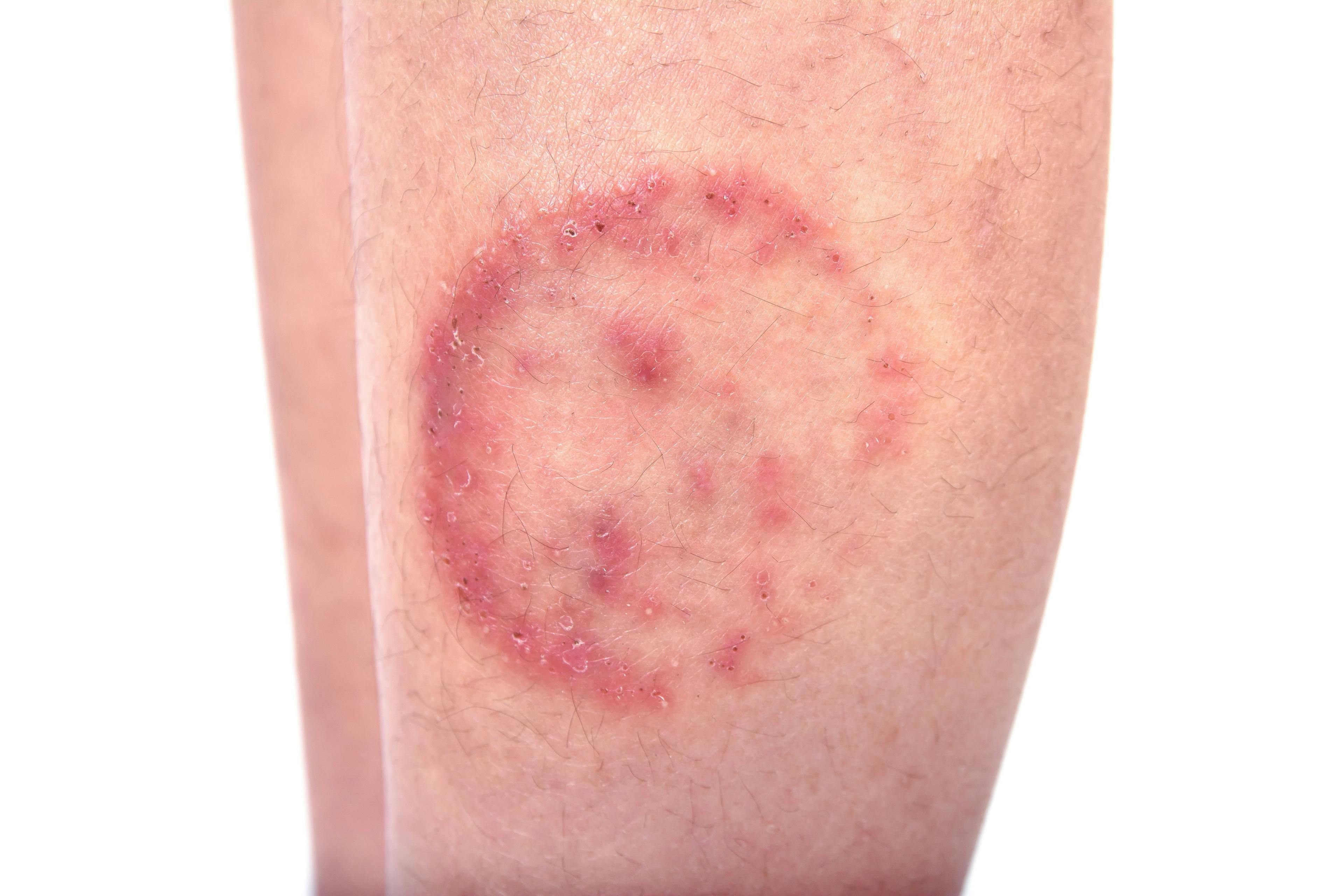 New, Difficult-to-Treat Fungal Skin Infections Are Emerging, Clinicians Warn