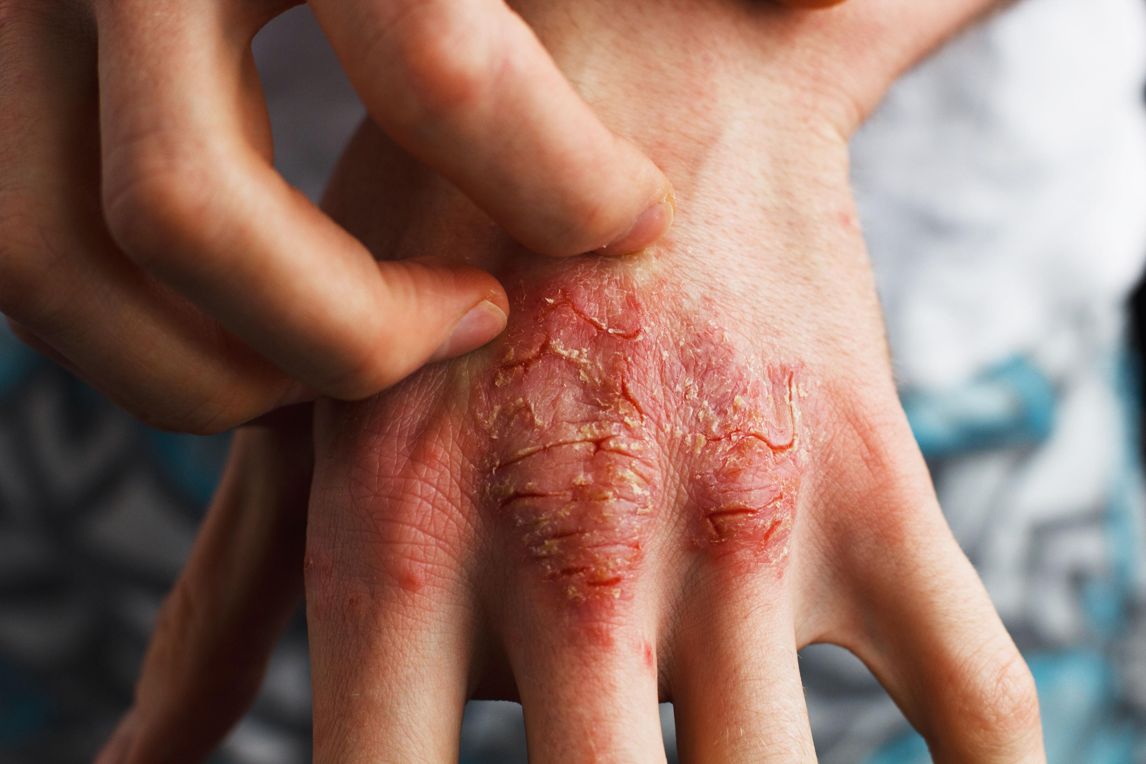 UCB Presents 4-Year Data on Bimekizumab for Plaque Psoriasis