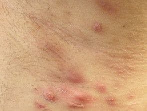 Hidradenitis suppurativa on the armpit