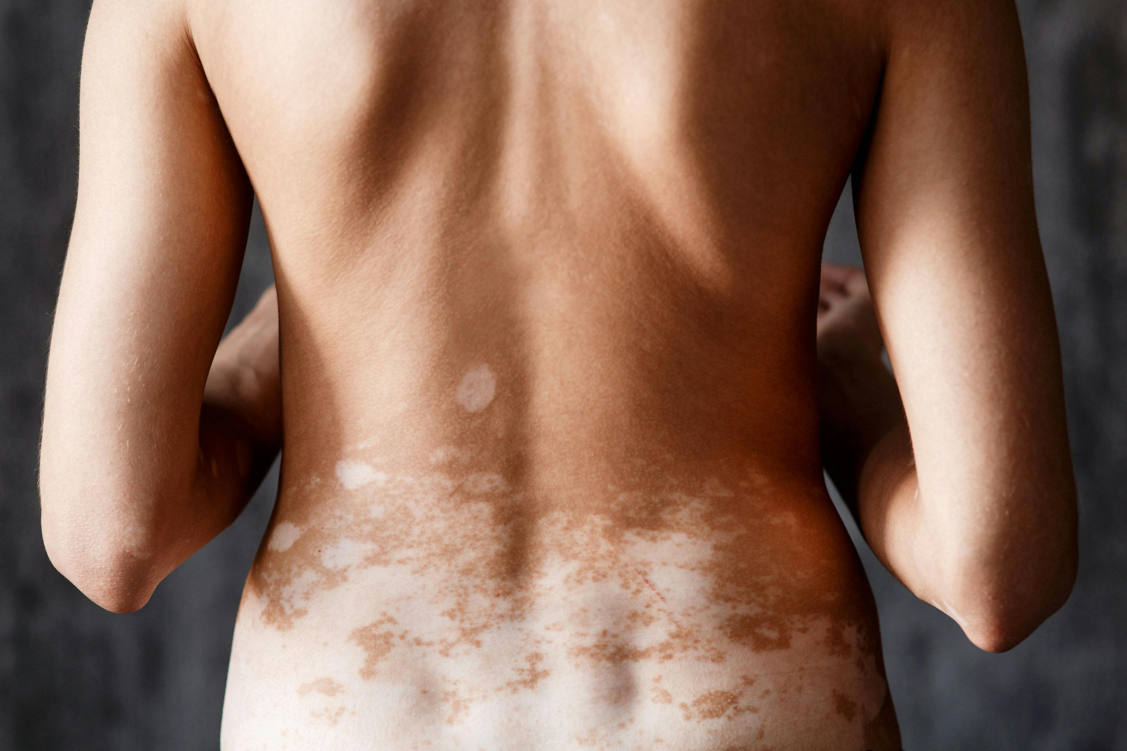 Person with depigmentation concentrated to their lower back