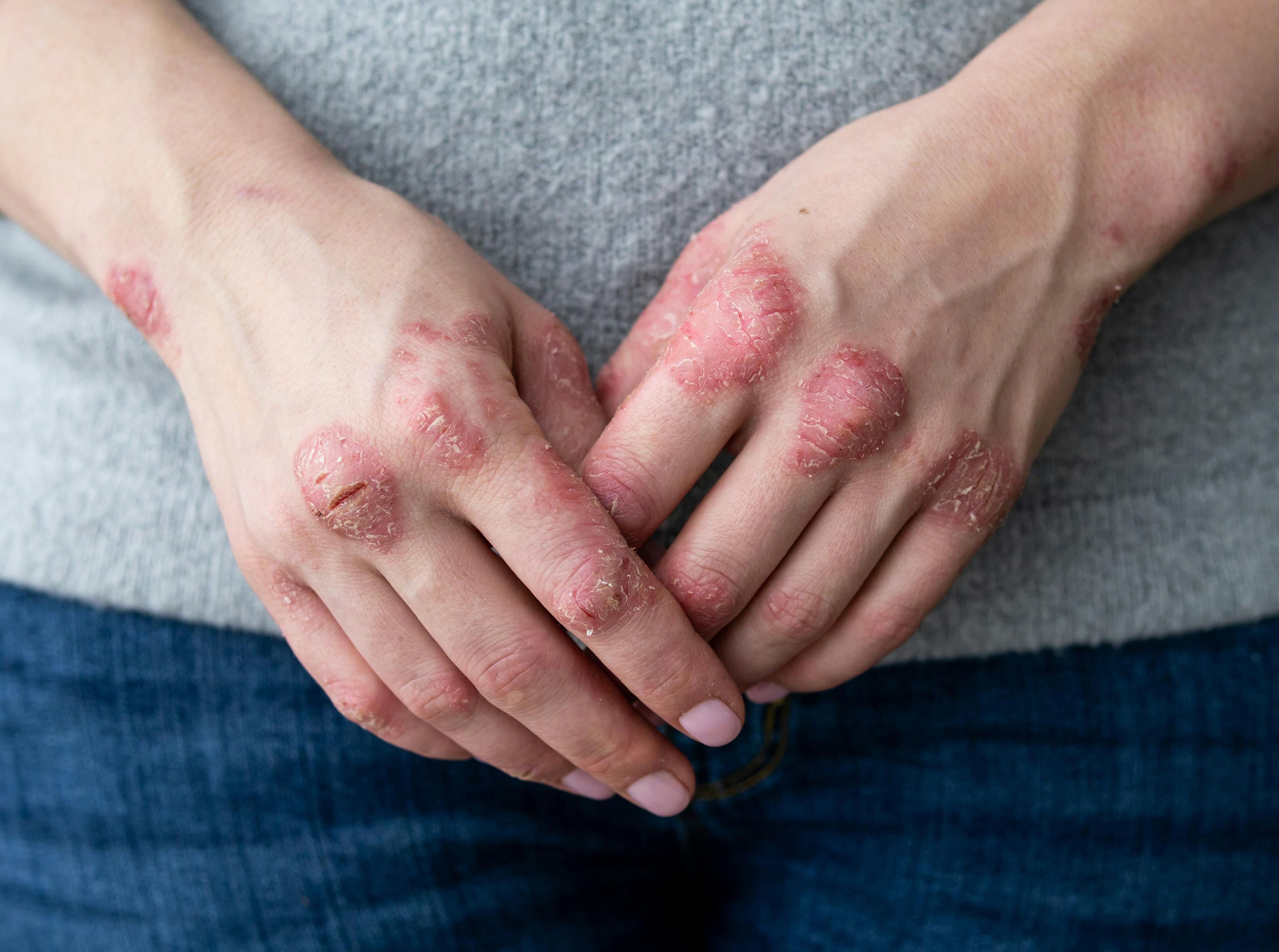 Close up view of psoriasis on the hands and knuckles