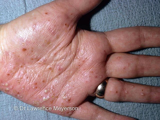 Palmoplantar Pustulosis on hand | Image Credit: © Dr Lawrence Meyerson - dermnetnz.org