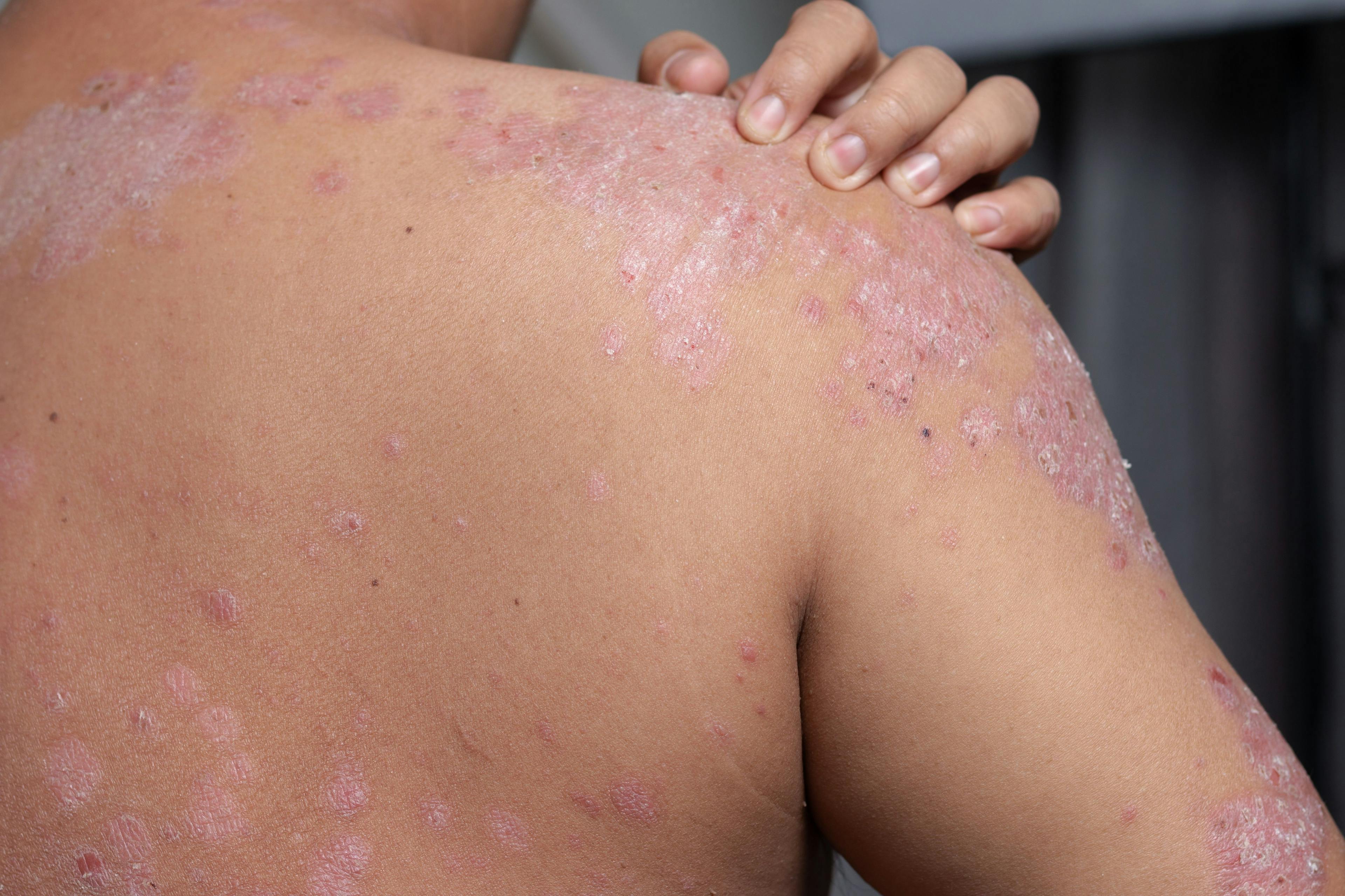 Man with psoriasis on the shoulder and back