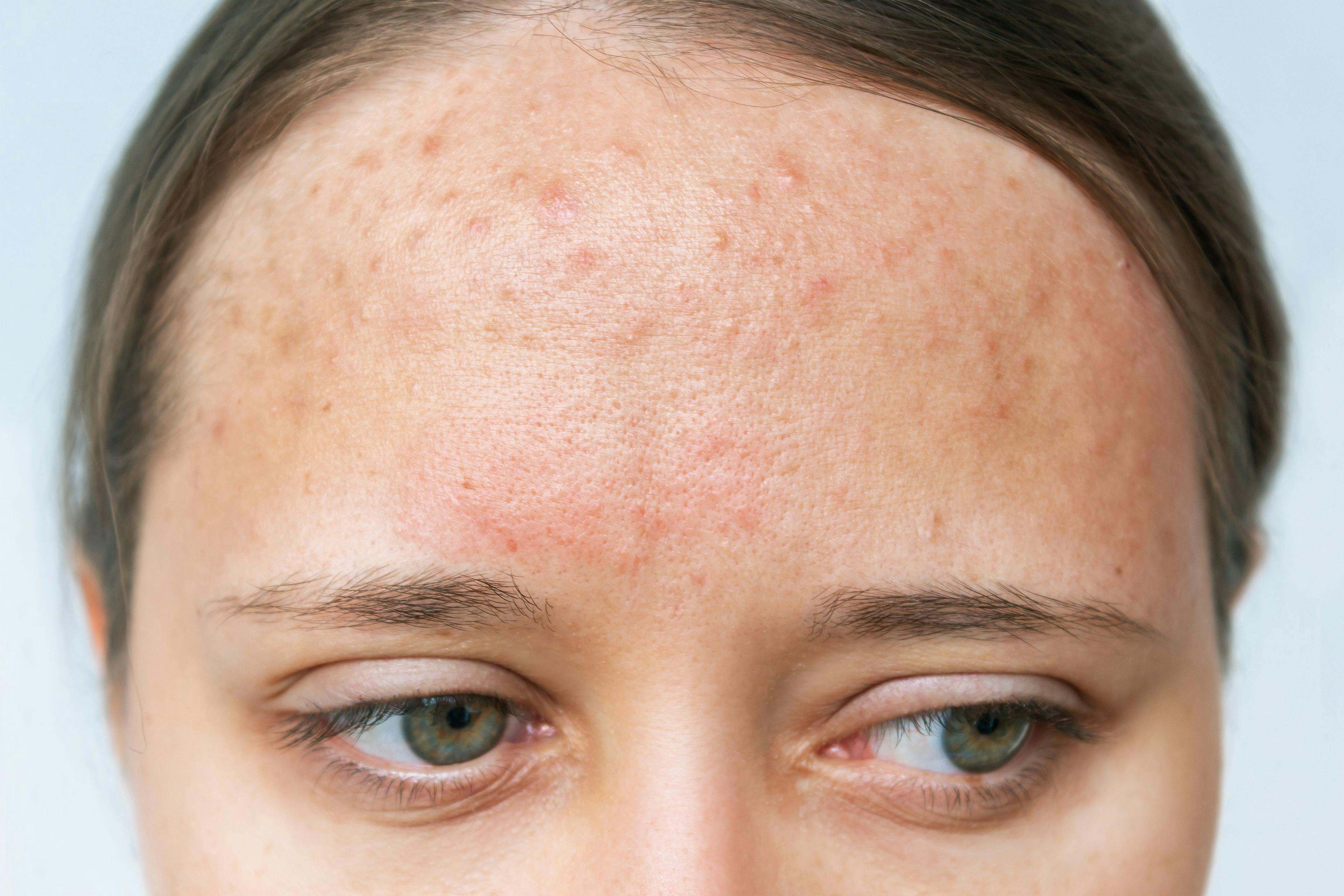 Optimizing Pediatric Acne Care with Hormonal Therapy