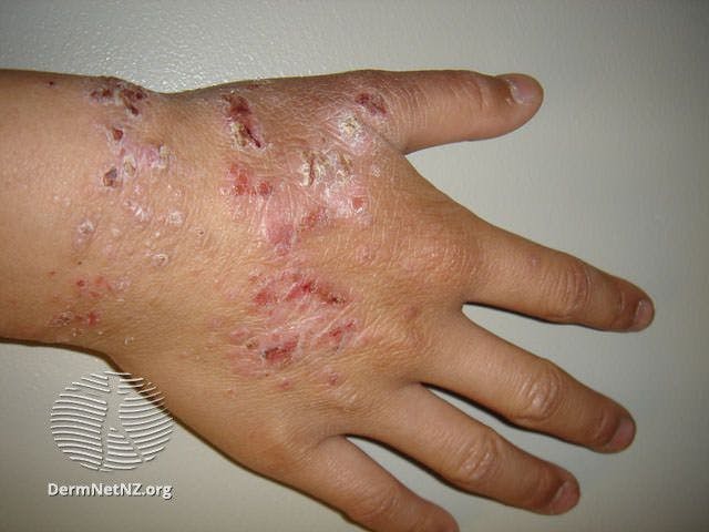 Atopic dermatitis of the hand | Image credit: DermNet