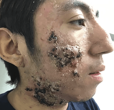 Patient with pseudo acne fulminans