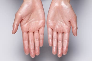 Test Your Knowledge: Hyperhidrosis Diagnosis and Treatment