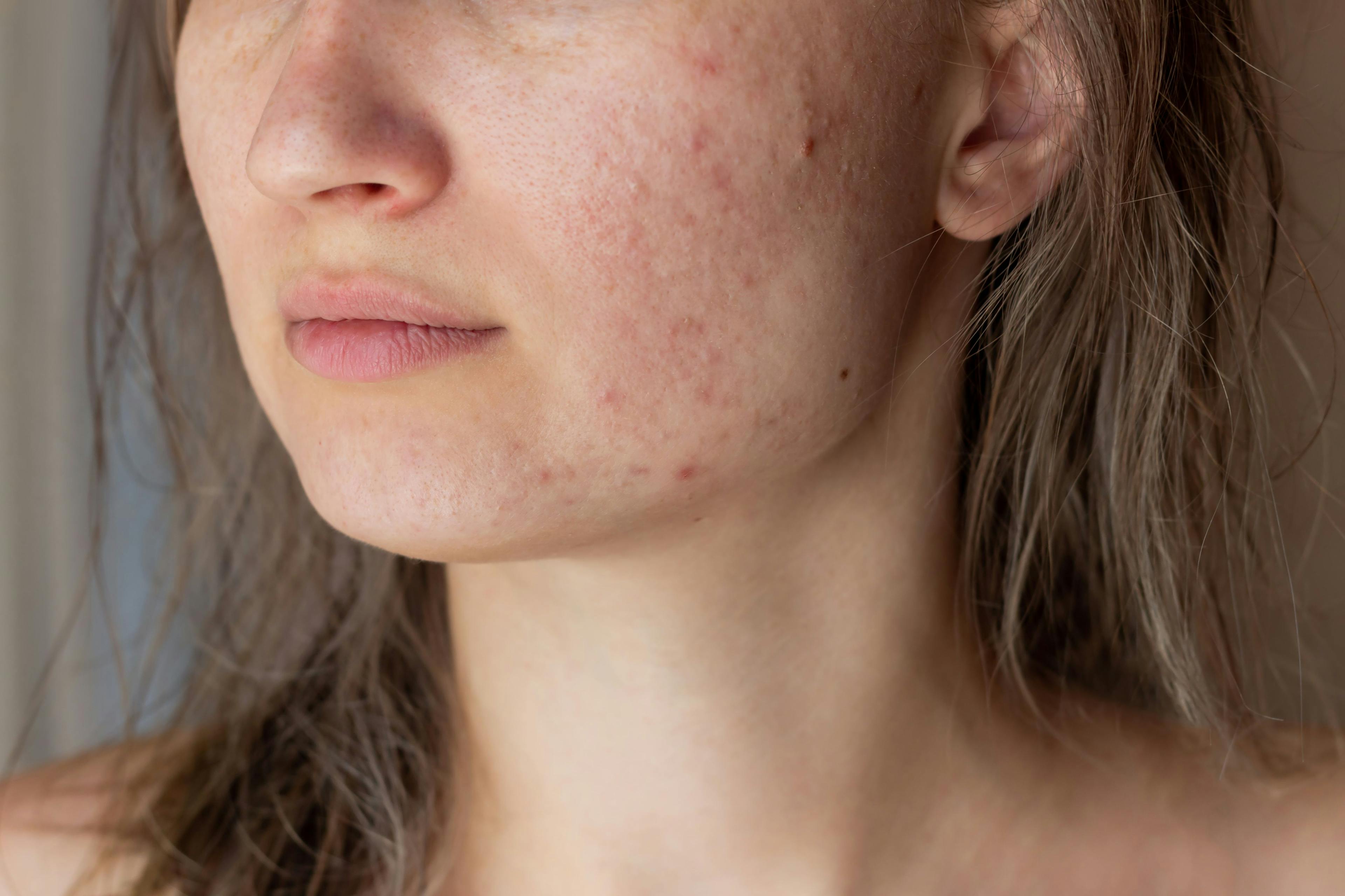 Patient with acne | Image Credit: © Марина Демешко - stock.adobe.com