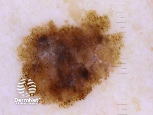 Melanoma in situ 12 dermoscopy