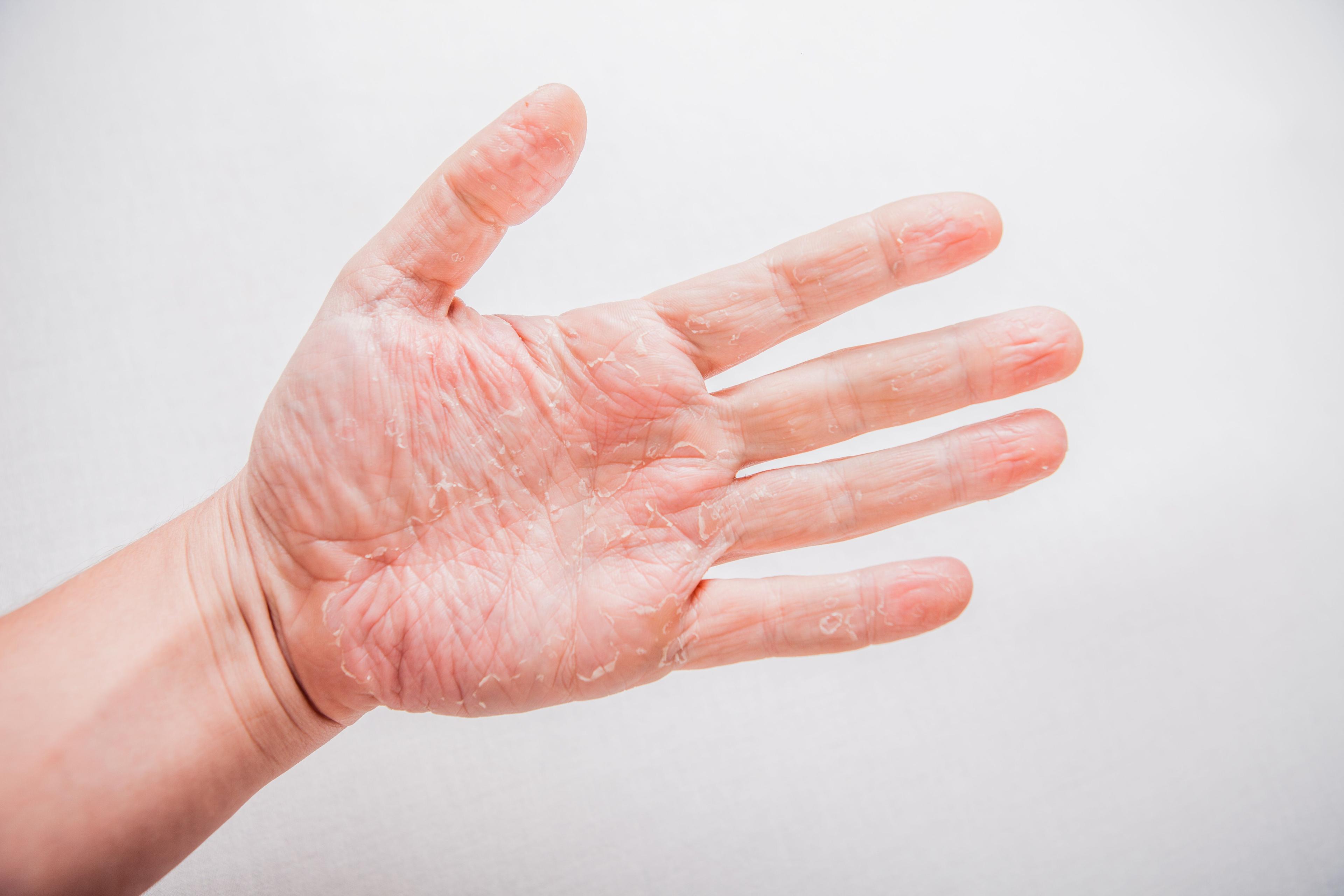 LEO Pharma Presents Prevalence, Severity, and Treatment CHECK Data for Chronic Hand Eczema