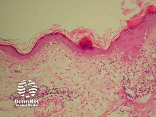 Dermatopathology of systemic lupus erythematosus