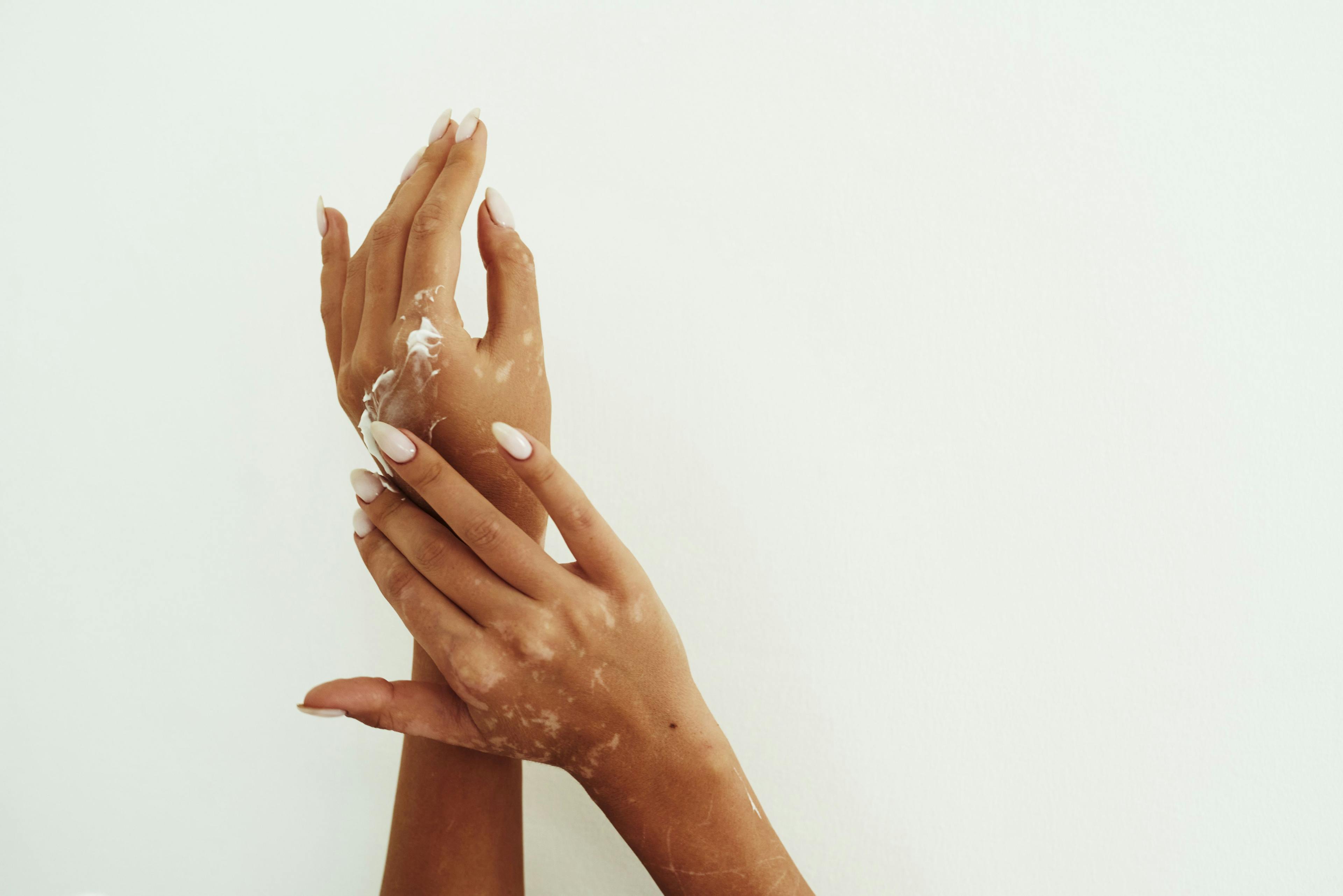 Woman with vitiligo on the hands applies a topical cream
