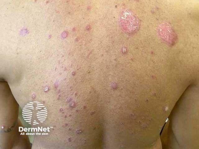 Chronic plaque psoriasis in a patient with skin of color | © Image credit: DermNet