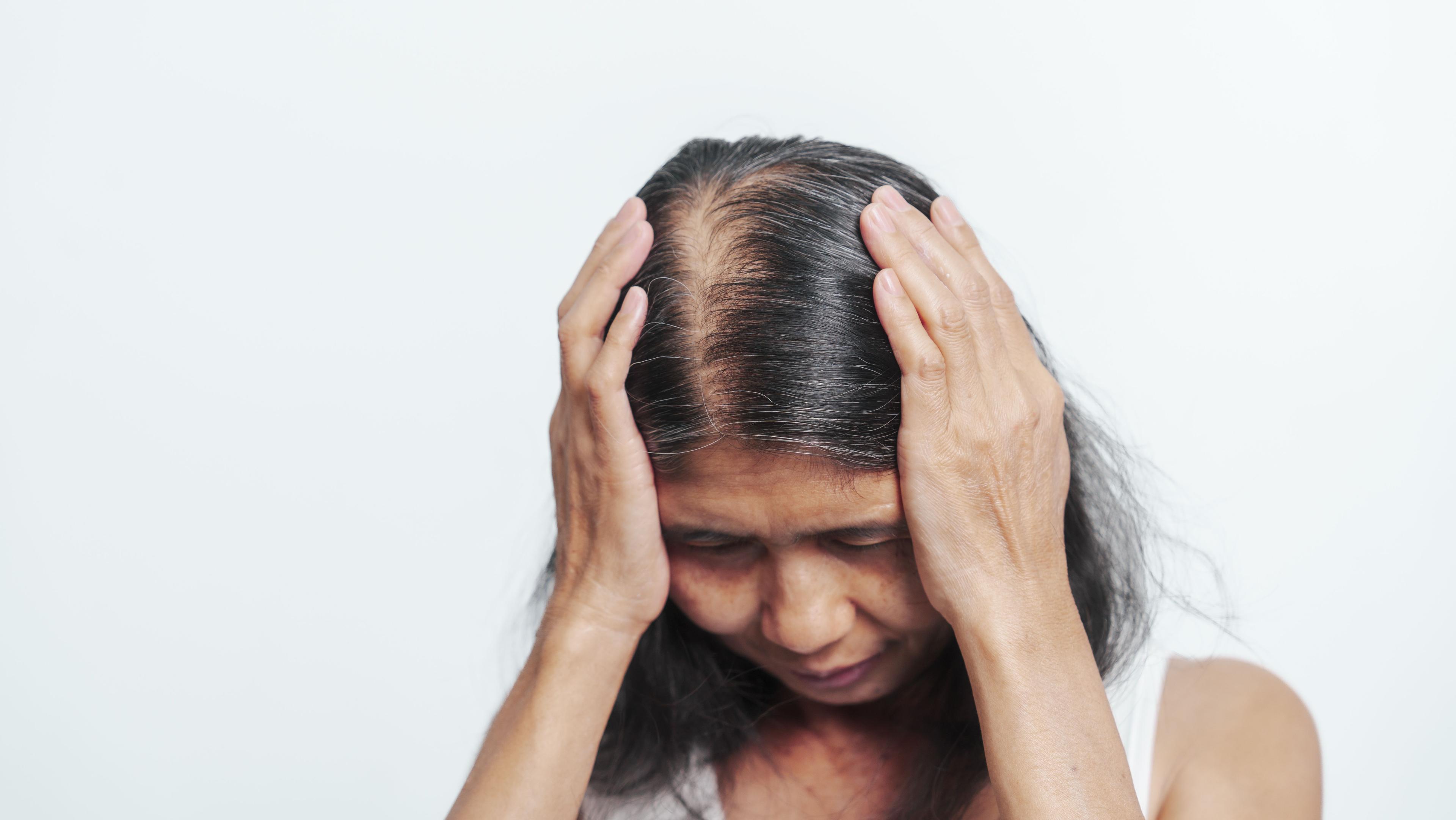 Patient with hair loss | Image Credit: © M+Isolation+Photo - stock.adobe.com