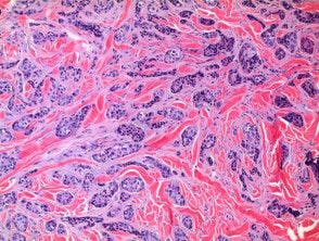 Metastatic adenocarcinoma pathology