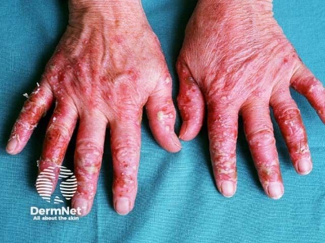 Palmar pustulosis