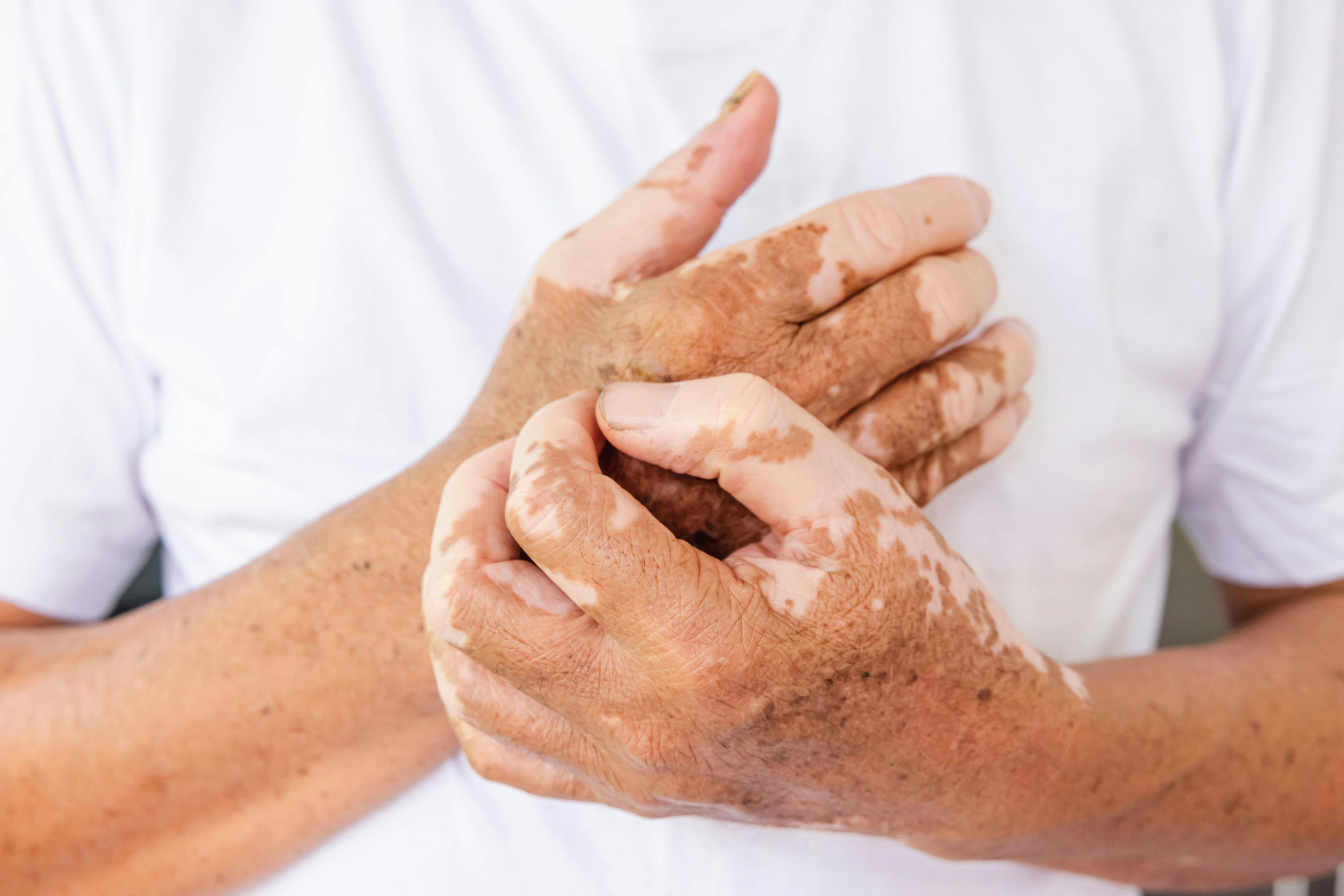 Vitiligo Leads to Heightened Risk of Rheumatoid Arthritis and Systemic Lupus Erythematosus, According to Mendelian Randomization