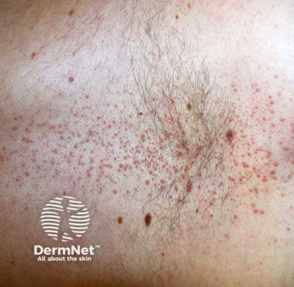 Follicular lichen planus